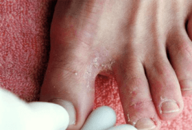jalgade seenhaiguse sümptomid